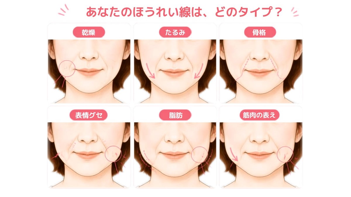 ほうれい線のタイプ（乾燥・たるみ・骨格・表情グセ・脂肪・筋肉の衰え）を口元のアップで描き分けた図