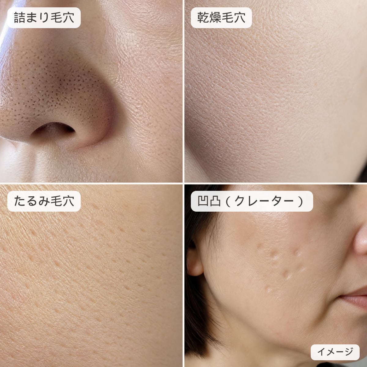 詰まり毛穴・乾燥毛穴・たるみ毛穴・凹凸（クレーター）の4タイプが、鏡に近づいたときにどう見えるかを並べたイメージ画像（実際のお客様の写真ではありません）
