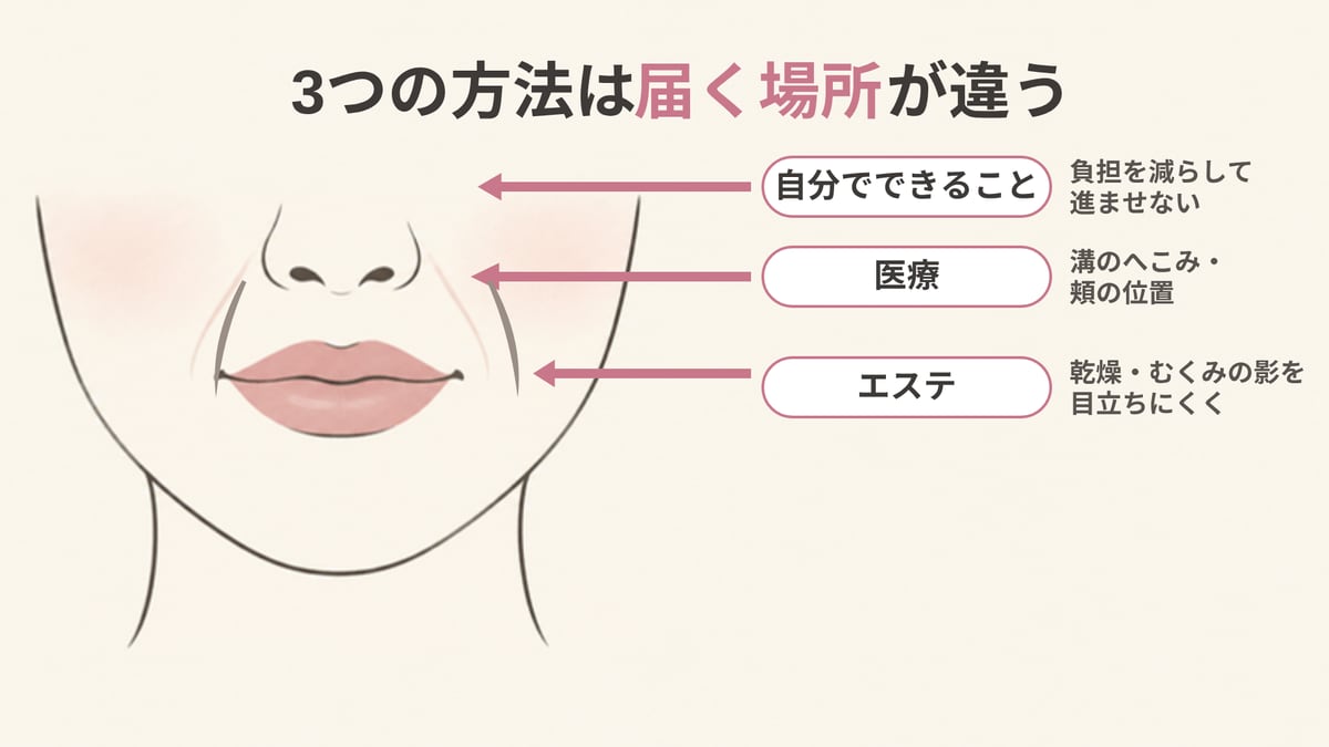 口もとの線画に、自分でできることは肌への負担、医療は溝のへこみと頬の位置、エステは乾燥やむくみの影へ矢印を向け、3つの方法は届く場所が違うことを示した画像