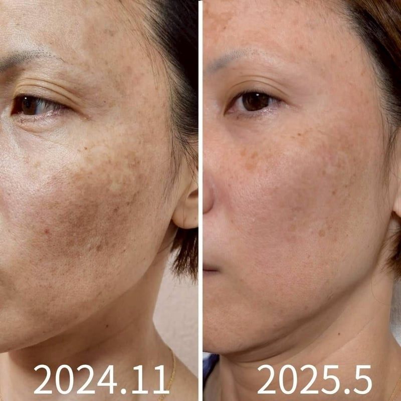 頬の肌のトーンとくすみが、2024年11月から2025年5月の約半年で変わった写真