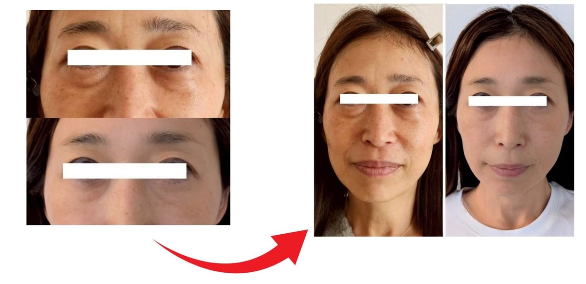 40代女性の目元のアップと顔全体の、施術前と6か月後の比較写真（メイクなし）