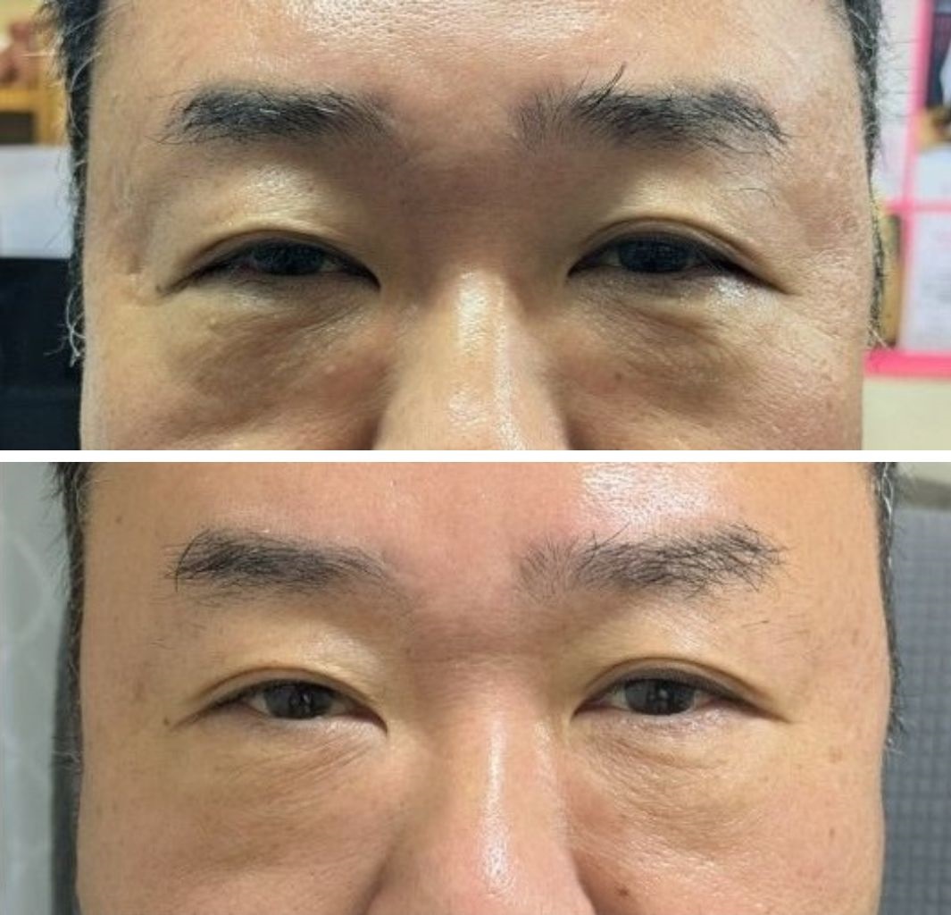 50代男性の目の下の施術前と4か月後の比較写真（メイクなし）